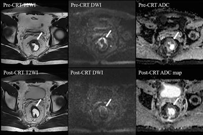 The role of MRI after neochemoradiotherapy in predicting pathological tumor regression grade and clinical outcome in patients with locally advanced rectal adenocarcinoma